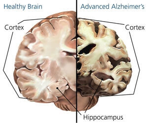 alzheimerin tauti aivot