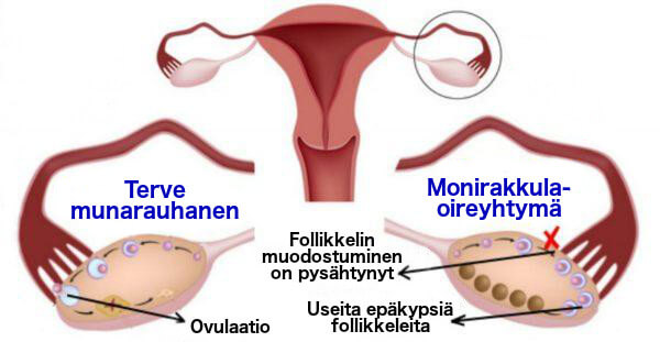 monirakkulaoireyhtymä