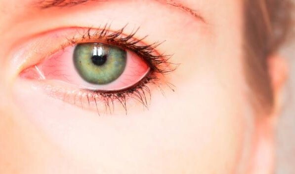 henkisen väkivallan oireet kehossa: verestävät silmät