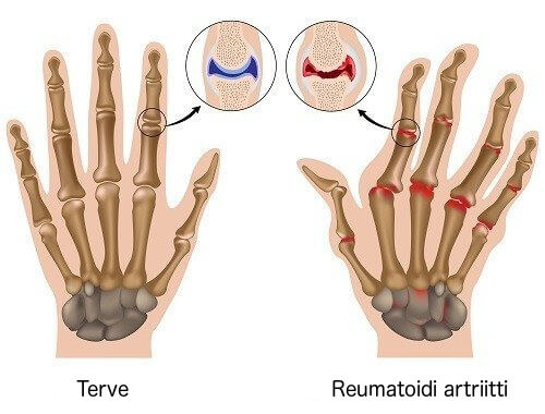 terve käsi ja käsi jossa reumatoidi artriitti