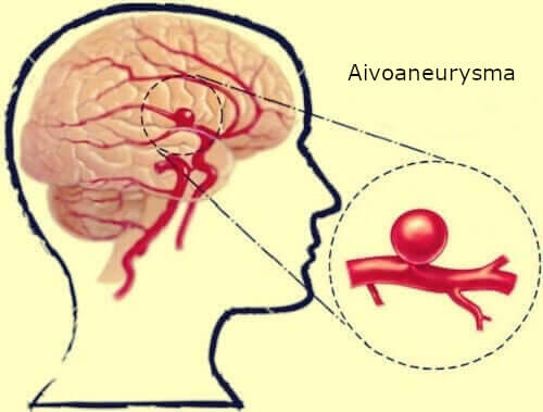 Aivoaneurysma