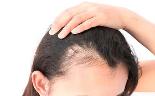 Alopecian psykologiset vaikutukset ovat naisilla lähes aina negatiivisia