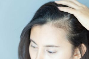 Alopecian psykologiset vaikutukset naisiin