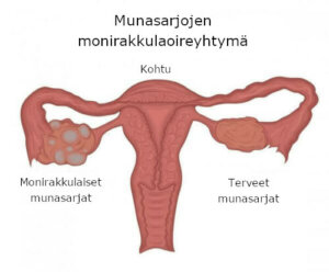 Munasarjojen monirakkulaoireyhtymä: oireet ja hoito